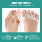 Silicone Toe Separators – Bunion Corrector & Toe Straightener